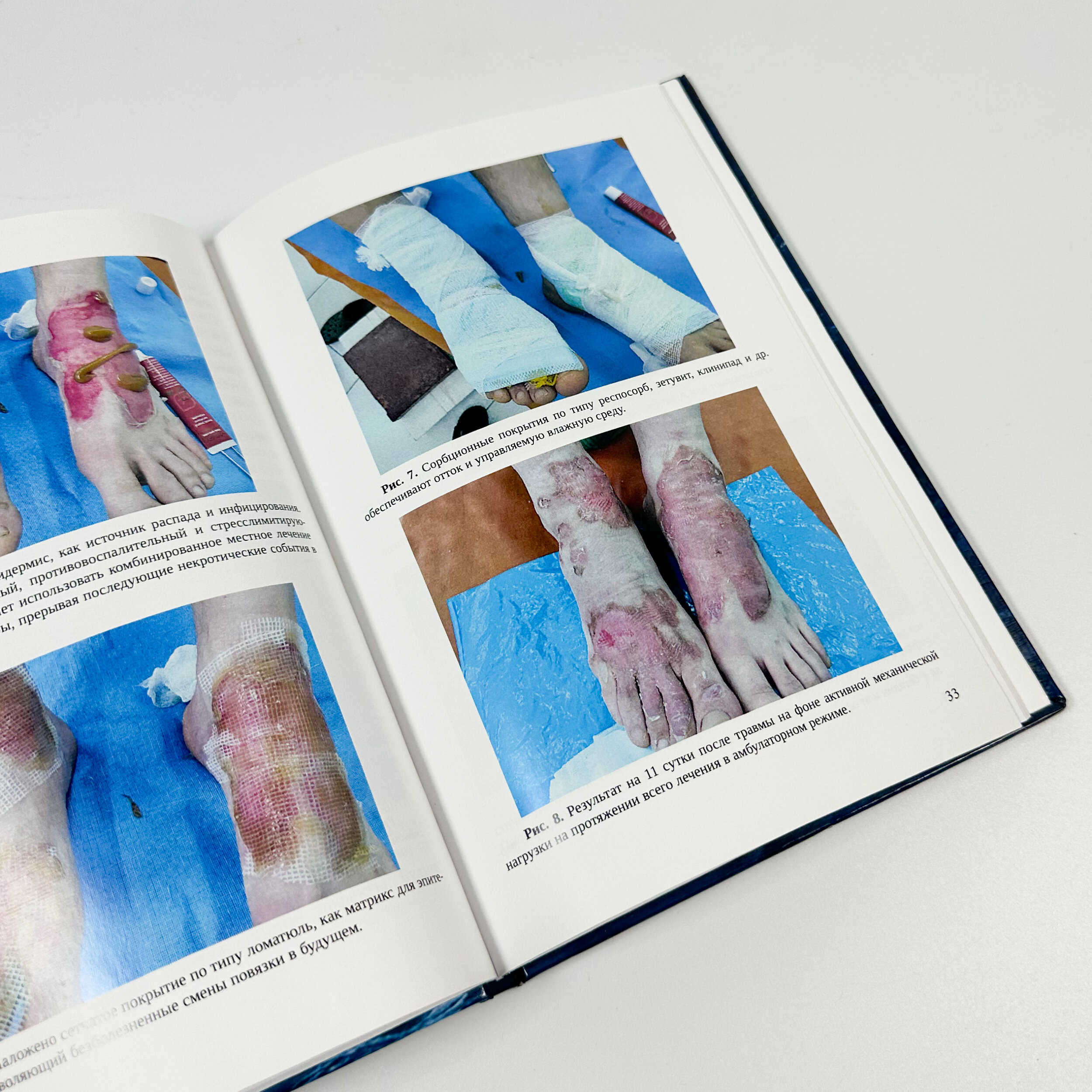 Повреждения кожи в практике комбустиолога. Автор — А.С. Садовой. 